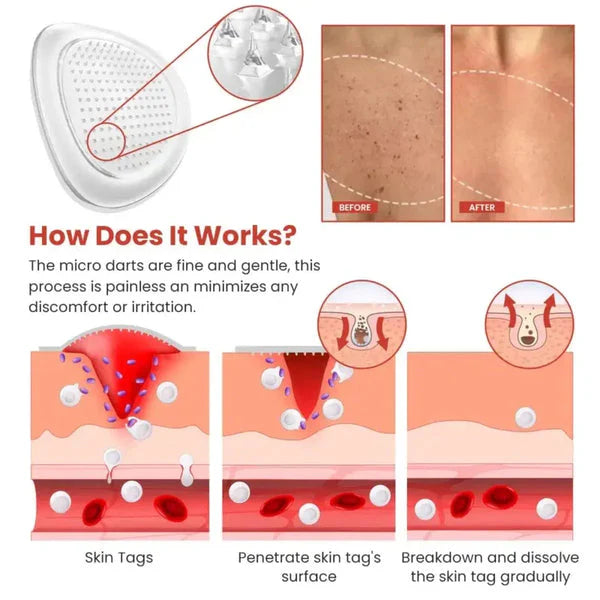 Derma Smooth™ Skin Tag Removal Patch – 100% Results, Painless & Fast